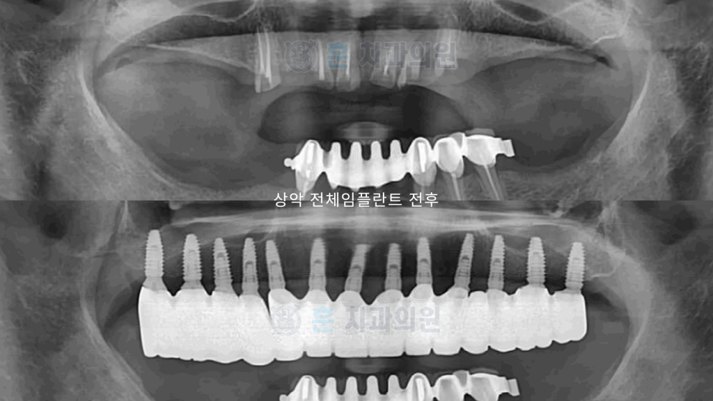 미아사거리 전체임플란트 전후